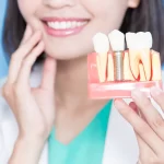 Implanty zębowe