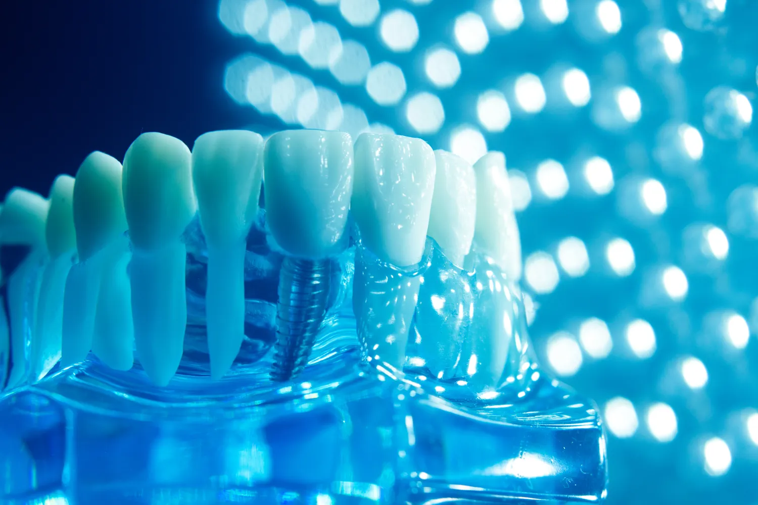 Najlepszy licówki Szczecin