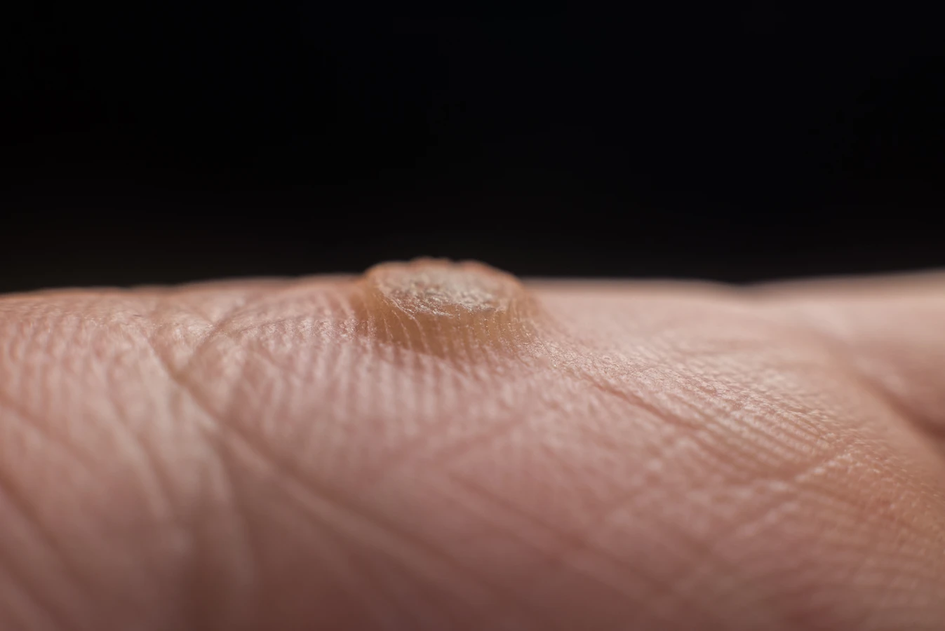 Jak usunac kurzajki ze stopy?